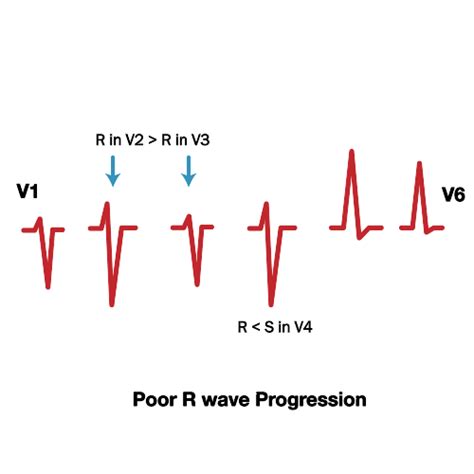 poor r wave progression in hindi|Poor R Wave Progression (PRWP) ECG Review .